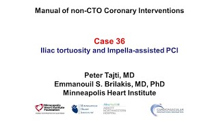 Case 36 PCI Manual  Challenges with Impellaassisted PCI [upl. by Neerahs]