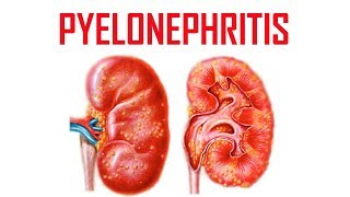 Pyelonephritis  Causes Symptoms amp Treatment  Iqbal Health Centre [upl. by Rod]