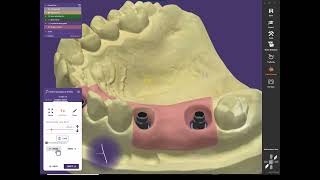 Exocad custom abutment 2nd video emergence profile [upl. by Nuahsar]