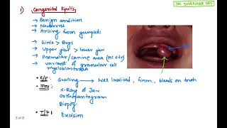 Epulis  Types Clinical Features Treatment  Surgery  Dr Shankar Dey [upl. by Lustig]