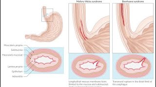 USMLE S2CK Uworld case no 33Boerhaave syndrome [upl. by Waal]