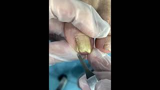 Best Satisfying Ingrown Toenail Removal [upl. by Mcquade568]