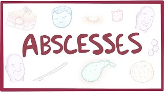 Abscesses  causes symptoms diagnosis treatment pathology [upl. by Polik]