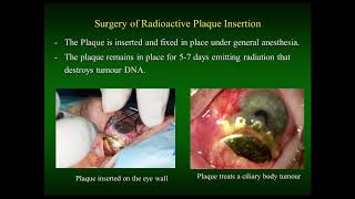 Uveal Melanoma Webinar Treatment Updates and Genetics [upl. by Tracey]