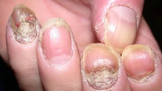 How To Treat Psoriasis of the Nails [upl. by Alves621]