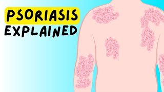 What is Psoriasis Definition Etiology Classification Pathophysiology Diagnosis Treatment [upl. by Osi405]