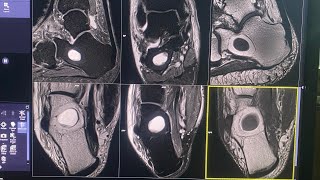 MRI ANKLE  Intraosseous Lipoma Of The Calcaneus [upl. by Eagle]