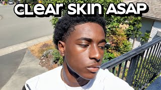 how to get clear skin for guys asap [upl. by Oirasan421]