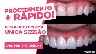 TRANSFORME SEU SORRISO Facetas e lentes de contato em resina composta Saiba tudo [upl. by Damita841]