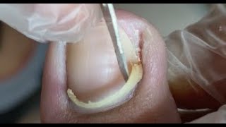 Super relief Clean all the cuticle under nail [upl. by Stead749]