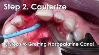 5 Easy Steps to Grafting the Nasopalatine Canal [upl. by Aisilef]