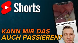 Schiefe Weisheitszähne shorts [upl. by Feldt]