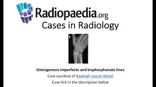 Osteogenesis imperfecta and bisphosphonate lines Radiopaediaorg Cases in Radiology [upl. by Ransome]