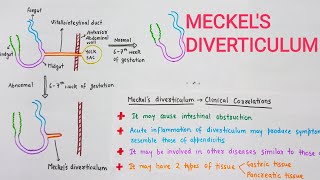 Meckels Diverticulum With Clinical Correlations [upl. by Phillane479]