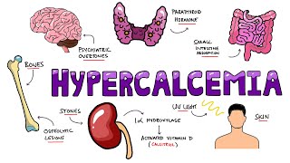 An Approach to Hypercalcemia  Causes Calcium Homeostasis Mechanisms amp Signs and Symptoms Mnemonic [upl. by Geneva656]