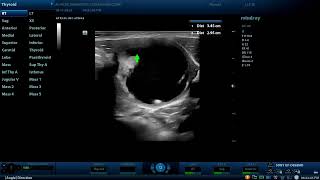 Large Thyroid colloid nodule Diagnostic ultrasound cases [upl. by Aihtnis]