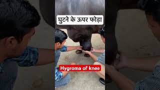 Hygroma of knee l dr Umar khan [upl. by Wilinski]