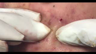 30 MINUTES OF EXTRACTING ACNE [upl. by Vasilis348]