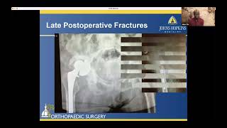 Total Hip Arthroplasty Periprosthetic Fractures [upl. by Marrin468]