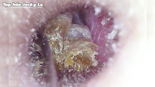 Ear Wax Removal 117 Please My Earwax Is So Itchy That I Cant Sleep  Ear Cleaning ASMR [upl. by Suirad]