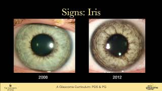 Pigment Dispersion Syndrome and Pigmentary Glaucoma [upl. by Gnidleif]