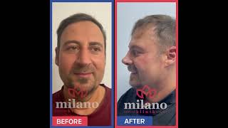 Rhinoplasty Surgery Before and After in Istanbul Turkey [upl. by Stearns]