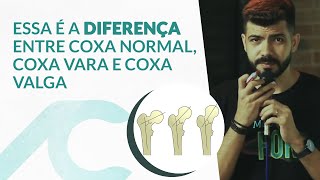 Diferença entre coxa normal coxa vara e coxa valga [upl. by Aillimac]