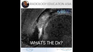 WHATS THE DX HIP MRI LABRUM MUCOID DEGENERATION [upl. by Aticilef]