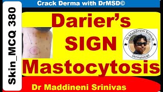 DARIERS SIGN  Mastocytosis  Urticaria Pigmentosa  Wheal  Histamine  Dermographism  DrMSD [upl. by Kamilah755]