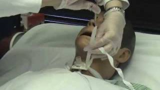 Trach Care Part 2mov [upl. by Ailiec]