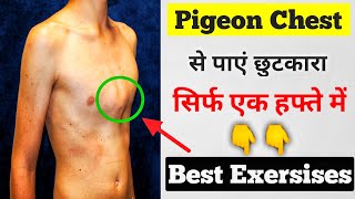 Pectus carinatum Exersises in hindi  Pigeon chest ko kaise thik kare  pigeon chest Exercise [upl. by Rockafellow]