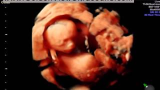 Hd live 17 weeks Goldenview Ultrasound Chicago [upl. by Carboni]