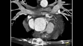 4D Imaging of the Aortic Valve Focal pseudoaneurysm of the ascending aorta 2 of 3 [upl. by Natalee146]