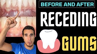 RECEDING GUMS  Before and after [upl. by Eelrefinnej]