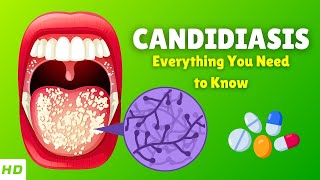 Candidiasis Candida Infection – Causes Signs and Symptoms Diagnosis amp Treatment [upl. by Ivgnout821]