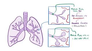 Respiratory Syncytial Virus and Bronchiolitis causes symptoms diagnosis treatment pathology [upl. by Naedan200]