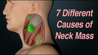 Adult Neck Mass 7 Different Causes Based on Location [upl. by Buller765]