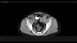 abdominal fascia on CT [upl. by Brandi471]