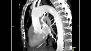 4D Imaging of the Aortic Valve Arch Pseudoaneurysm 3 of 8 [upl. by Chute]