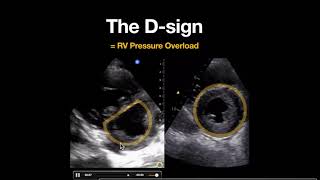 The D Sign PSSA [upl. by Munson]