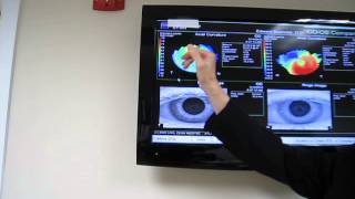 AN EXPLANATION OF CORNEAL TOPOGRAPHY AND KERATOCONUS [upl. by Tatum]