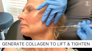 PDO Threads for a NonSurgical Neck Lift [upl. by Dar]