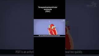 Paroxysmal supraventricular tachycardia PSVT [upl. by Jerrilee]