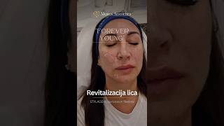 Lifting lica hijaluronskim filerima Forever young Medica Aesthetica skincare filler facelift [upl. by Akins]