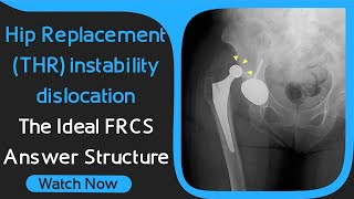 Hip Replacement THR instabilitydislocation  The Ideal FRCS Answer Structure [upl. by Almeida]