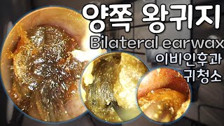 귀팡 ASMR 양쪽 왕귀지 Bilateral earwax이비인후과 귀청소ASMR no talking [upl. by Nemajneb275]