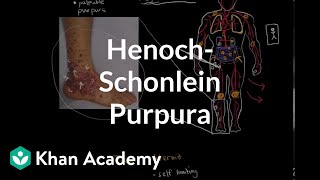 HenochSchonlein purpura  Circulatory System and Disease  NCLEXRN  Khan Academy [upl. by Mitchell]