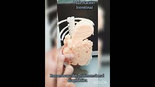 La TAC con Reconstrucción Tridimensional en Malrotación intestinal [upl. by Ahseikram]