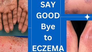 Management guidelines of eczema skin specialist advice How to treat eczemaskinhealthvitality5959 [upl. by Pammy]