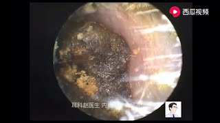 Hard cerumen destructive cholesteatoma soft fungi 12 minutes [upl. by Schnell]